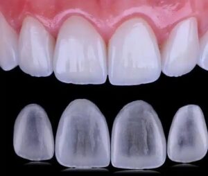 Lentes de Contato Dental