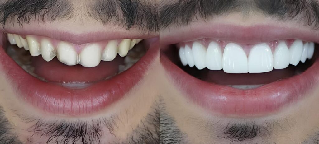 Lentes de Contato Dental